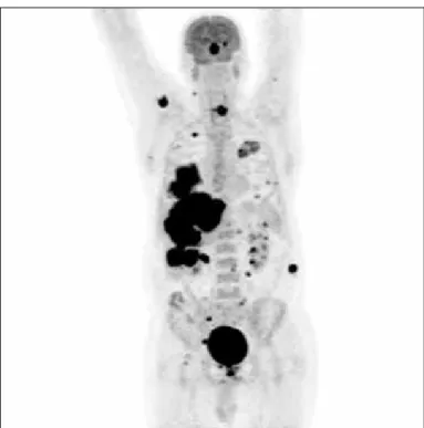 Figure 3. Widespread hypermetabolic metastatic lesions in the right 