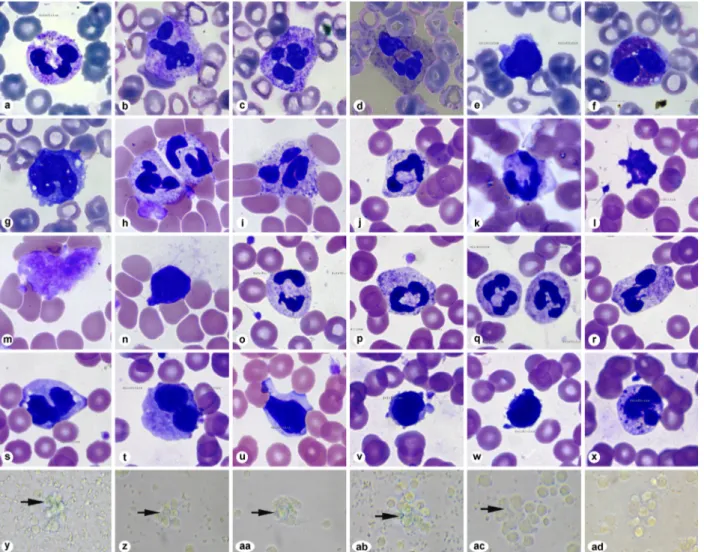 Figure 1. Dysmorphic hematological features of the peripheral blood smears of patient ASİ with chronic ITP (a–g), patient MEY with 