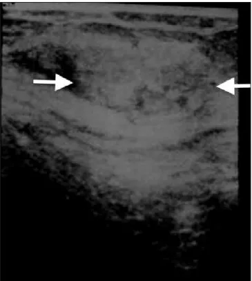Figure 2. Mixed echogenicity on ultrasound in the oval-shaped mass