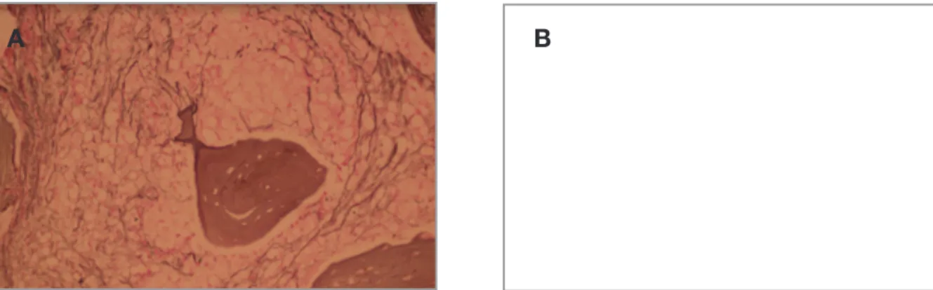 Figure 1A and B. Bone marrow fibrosis (Reticulin staining, x400, A. Grade 2 myelofibrosis; B