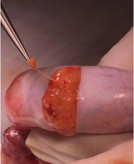 ġekil  4:  Mikro-TESE  operasyonu  sırasında  saptanan  dilate-sarı  renkli,  sperm  olması  muhtemel 
