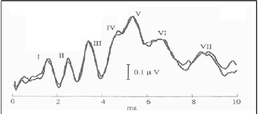 Şekil 2.2: ABR dalga morfolojisi örneği 