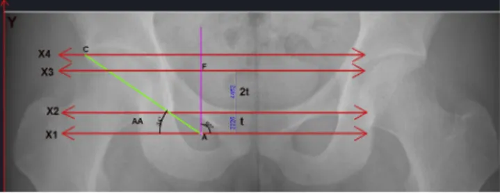 Fig. 4. Geometrical-based measurement method for the acetabular angle (AA). The AA is the angle formed between the CA and X1 lines.