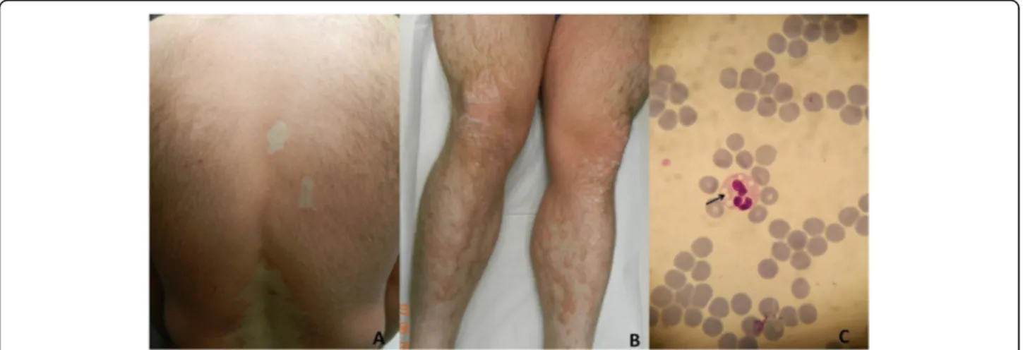 Fig. 2 Clinical presentation of CDS patient. Erythematous and scaly lesions on back (a) and lower limbs (b) with uninvolved areas