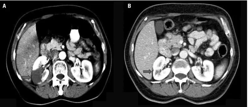 Figure 1. A, B. Contrast-enhanced abdominal computed tomography images at the same level