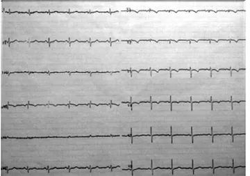 Fig. 1. 12-lead electrocardiogram showing negative T waves in an- an-terior chest leads during chest pain at rest