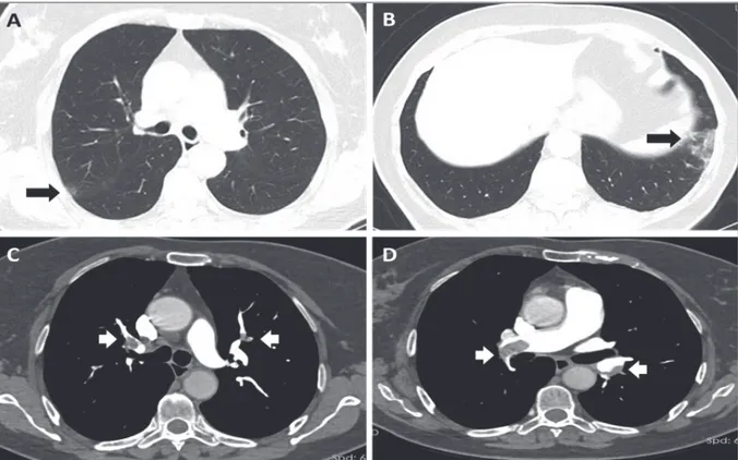 Figure 1. CT of thorax. A and B showing parenchymal changes resembling COVID-19 pneumonia; C and D showing massive acute 