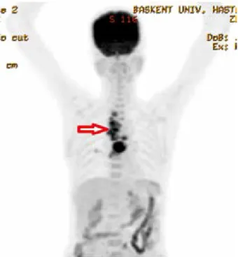 Fig. 4. PET CT images of patients