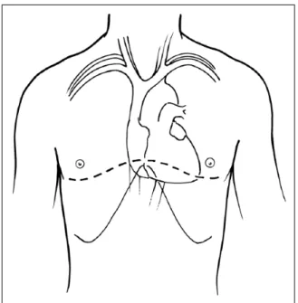 Fig. 1. The line of a clamshell (bilateral chest) incision.