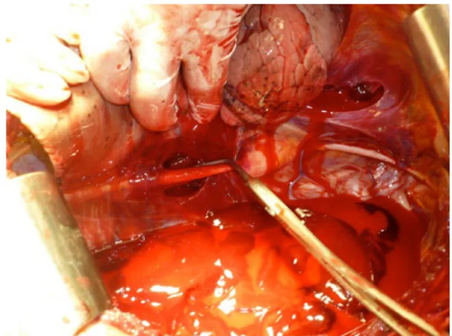 Fig. 2. Control of pulmonary hilum using a finger, followed by the  insertion of a clamp