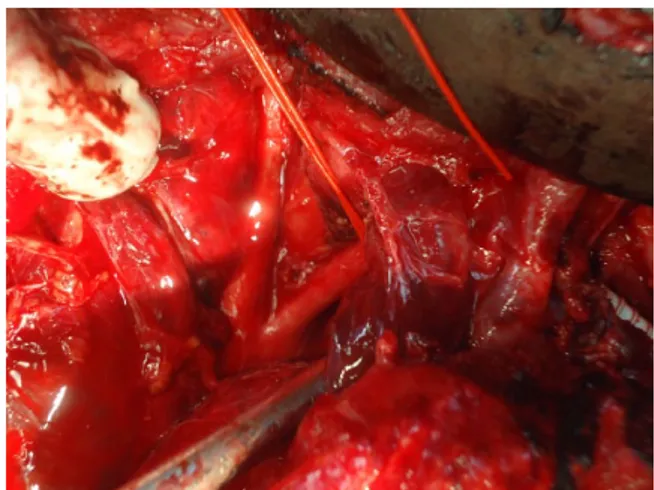 Fig. 6. Sternotomy and a supraclavicular incision for injuries of the  proximal left subclavian artery