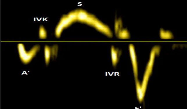 Şekil  2.3.  Doku  Doppler  ile  elde  edilen  dalgalar.  (İVK:  pik  izovolümetrik  kontraksiyon  dalgası,  S:  pik  sistolikdalga,  IVG:pik  izovolümetrik  gevşeme  dalgası  E’:  pik  erken  diyastolik dalga, A’:pik geç diyastolik (atriyal) dalga) 
