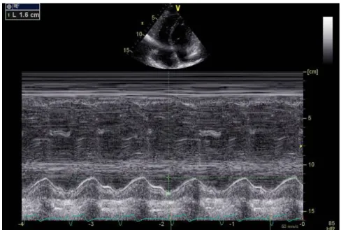 Şekil 3.4. Pulmoner kapak maximum gradient ölçümü ve PY değerlendirilmesi 