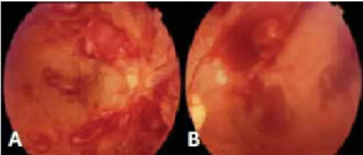 Figure 1. The retinal hemorrhages of patients with acute leukemia (A, right eye; 