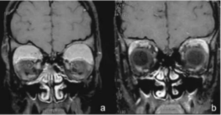 Figure 5. Orbital magnetic resonance images of patient with orbital granulocytic 