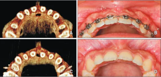 Figure 2. A, Computed tomo graphy (CT) image (axial slice) from the maxillary anterior region acquired from Patient 2 at 