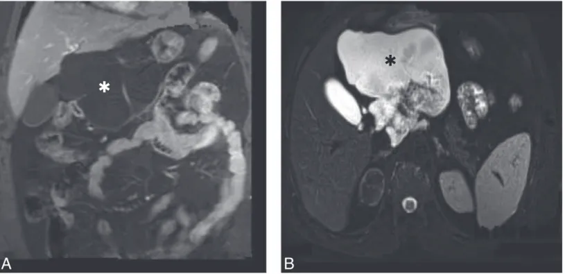 Fig. 2. — Lobulated pure cystic lesion without any solid component is seen on coronal plane contrast-enhanced, fat saturated SE 