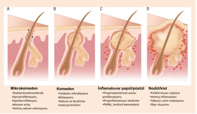 Şekil 2.3.  Akne  vulgaris  patogenezi  A.  Mikrokomedon  oluşumu,  B.  Foliküler 