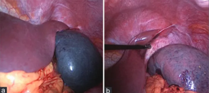 Figure 2: (a) A laparoscopic appearance of partially torsioned spleen. The 