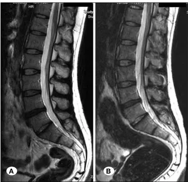 Figure 4: Pre-intervention (A) and post-intervention (B) T2 weight- weight-ed sagittal magnetic resonance images