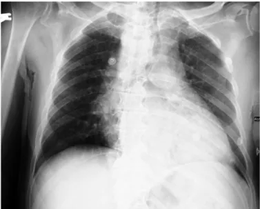 Figure 1. Chest radiograph showing no infiltrates on the day of 