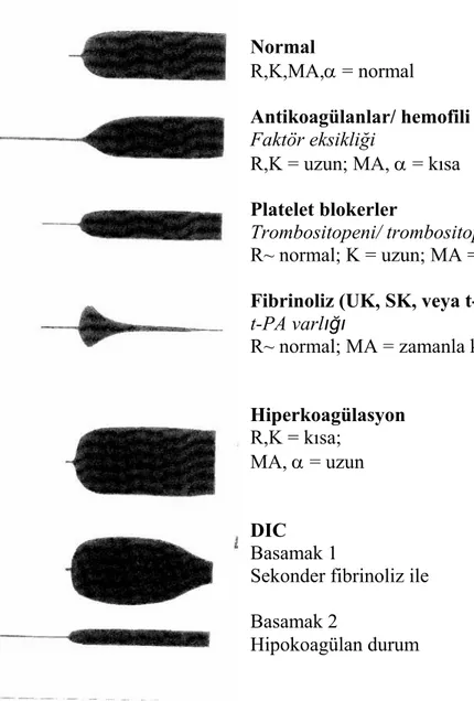 Şekil 4. Tromboelastografide tanısal paternlerNormal 