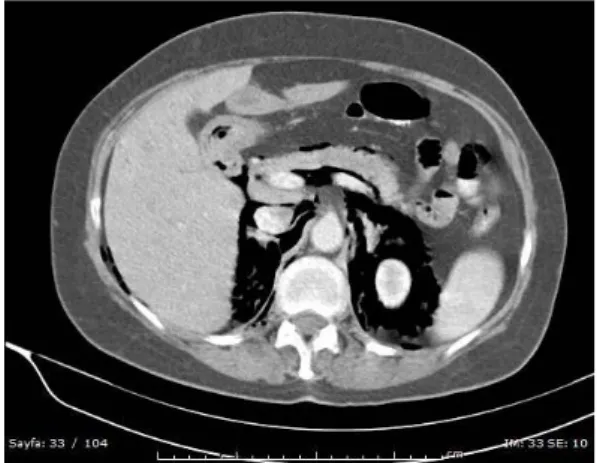Figure 1. Retroperitoneal and peripancreatic diffuse  free air densities in the IV-oral contrasted axial  abdominal CT scan