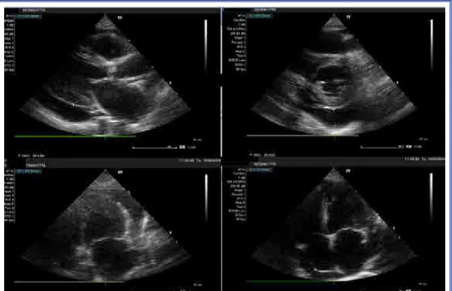 Figure 1.  Right ventricular diastolic collapse, severe pericardial effusion.