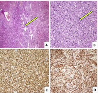 Fig. 3. (A) Tumor areas inﬁltrating the hepatic parenchyma (shown with yellow arrow). (B) Perivascular epithelioid cells with round to ovoid nuclei and abundant eosinophilic cytoplasm, which are occasionally spindle-shaped but mostly  epithe-lioid (shown w