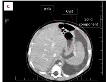 Figure 1.   MRI and US findings of the intraabdominal lesion.  ( A ) MRI at 2 months of age, a pure cystic lesion