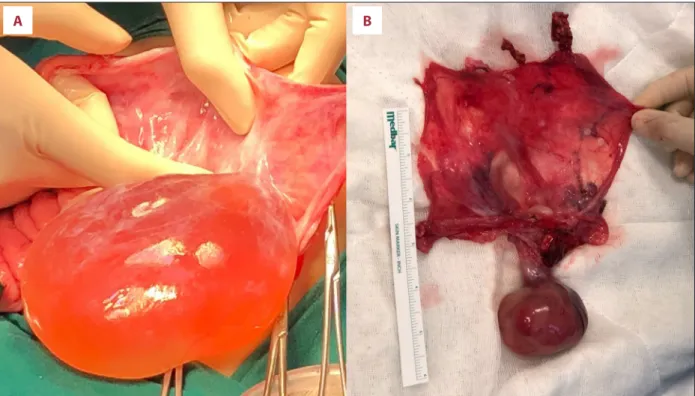 Figure 2.   During laparotomy, a clear serous fluid-filled intact sac with a solid component was detected ( A )