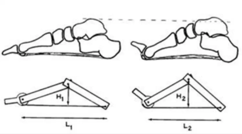 Şekil 2.3. Plantar fasyanın  çıkrık mekanizması. Plantar fasya kalkaneustan başlayıp  ayak  önüne doğru ilerler ve MTP eklem volar kapsülüyle birlikte fleksör tendonlara yapışır