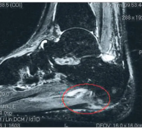 Şekil 2.6. Yukarıdaki resimde T2 ağırlıklı ayak bileği MR görüntüleme sagittal kesitinde  plantar fasyanın travmatik yırtığı görülmektedir