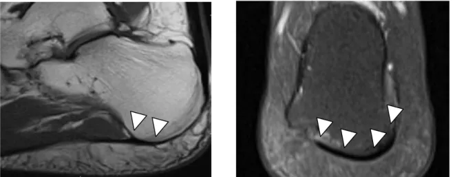 Şekil  3.5.  Plantar  fasyanın  kalkaneusa  yapıştığı  yüzey  hem  sagittal  hem  de  koronal  düzlemde içbükey bir yapıya sahiptir ve üç boyutlu yapışma alanı oluştururlar