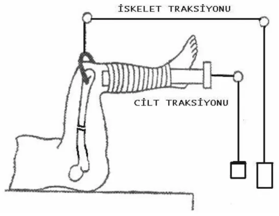 Şekil 17. İskelet ve Cilt tarksiyonları 