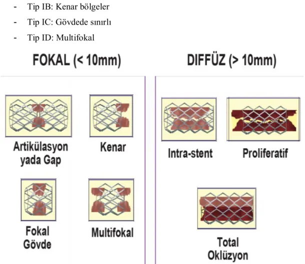 Şekil 2.7. Stent içi restenoz (Mehran Sınıflaması)