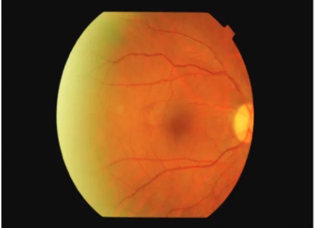 Figure 4. During follow-up, the patient’s best corrected visual acuity in the right 