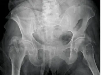 FIGURE 1. Bilateral heterotopic ossification of hips.
