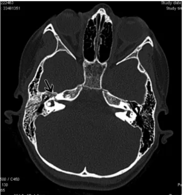 Figure 4. The fracture line which crossed the geniculate ganglion section 