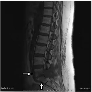 Figure 1.  L5 and S1 vertebral body shows low signal  intensity on T1-weighted image (white arrows) 