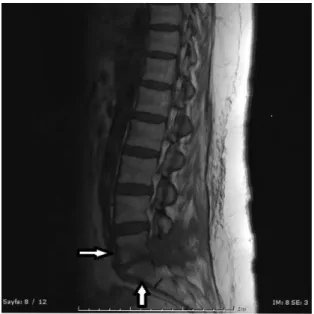 Figure 1.  L5 and S1 vertebral body shows low signal  intensity on T1-weighted image (white arrows) 