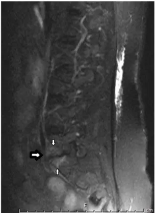 Figure 2.  L5 and S1 vertebral body shows high signal  intensity on T2-weighted image (white arrows) 