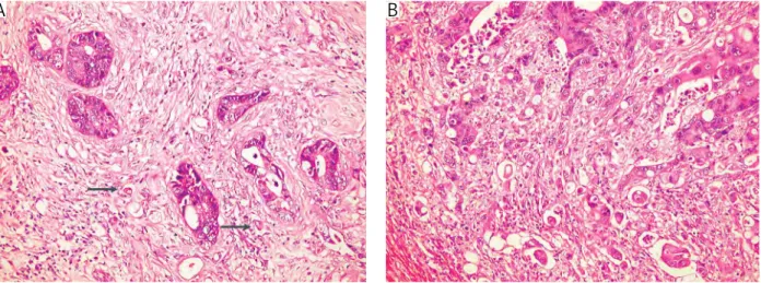 Fig. 1. Low (shown by arrows) and high score intratumoral budding (HE, magnification 200×)