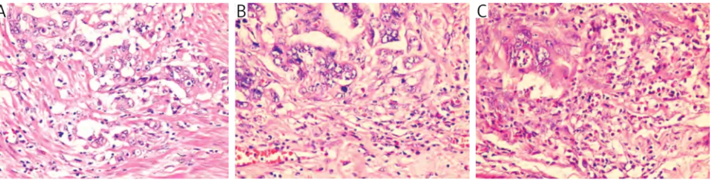Fig. 4. The intensity of eosinophil infiltration in order to minimal, moderate and severe (HE, magnification 400×)