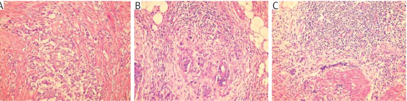 Fig. 6. Peritumoral lymphocyte infiltration in order to minimal, moderate and severe (HE, magnification 200×)