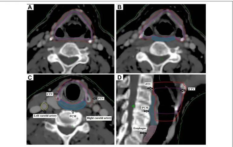 Figure 1. Delineation of target and organ at risk volumes.