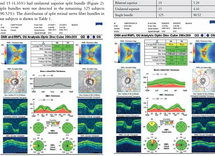 Table 1. Distribution of split retinal nerve fiber bundles in the  study subjects