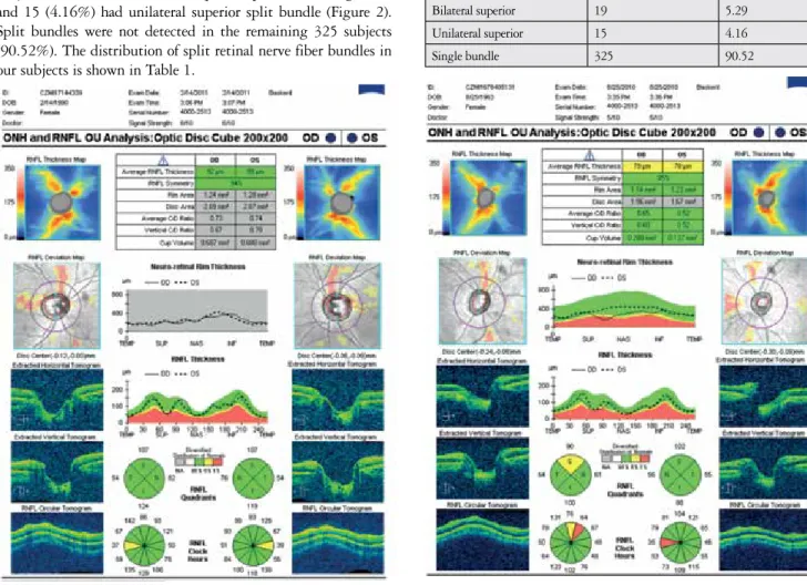 Table 1. Distribution of split retinal nerve fiber bundles in the  study subjects