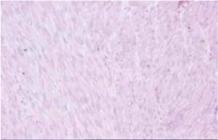 Figure 1. Tumor composed of elonged, plump cells with blunt  ended, sometimes hyperchromatic nuclei (H&amp;E; x200) 