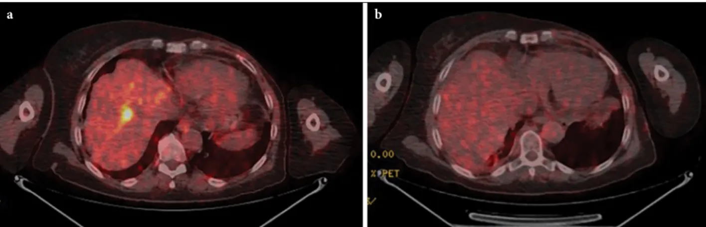 Fig. 1.  (a) The positron emission tomography (PET-CT) images of a representative patient demonstrating liver metastasis 